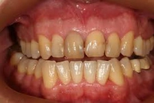 Diş Eti İltihabı İlaç Kullanımı ve Faydaları Nelerdir?