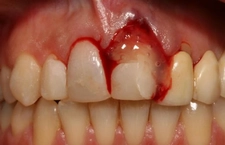 Ön Diş Ağrısı Nedenleri?