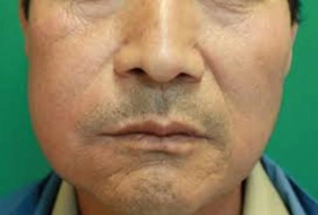 Diş Yanak Şişmesi Belirtileri ve Tedavisi