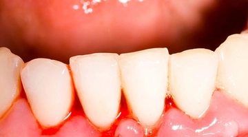 Diş Eti Kanaması Tarifi ve Malzemeleri