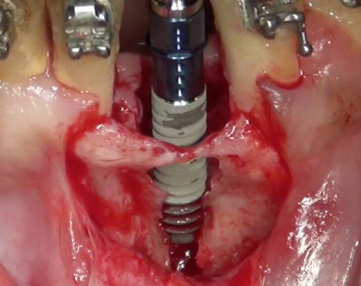 Ameliyatla Diş Çekimi