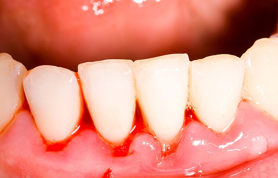 Diş Kanaması, Belirtileri ve Tedavisi dishastaliklari.gen.tr